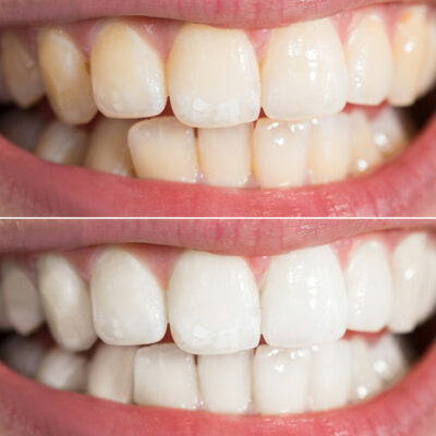 5 Effective Teeth Whitening Tips