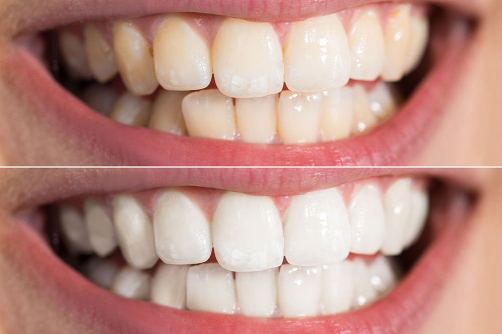 5 Effective Teeth Whitening Tips