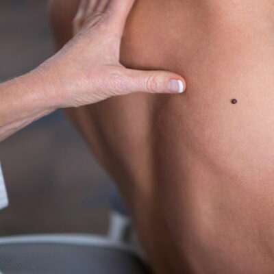 Early Signs and Natural Remedies to Manage Melanoma